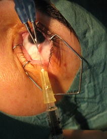 Ojo humano en una operación